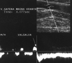 Resim 1. Safenofemoral yetmezlik. Spektral incelemede vena safena magna kranyal segmentinde Valsalva manevras ile 1000 msn üzerinde devam eden reflü izleniyor.