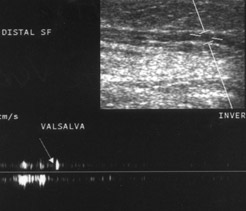 A B Resim 2. Safenofemoral yetmezlik. A. Vena safena magnan n diz medialindeki kaudal segmentinde spektral incelemede Valsalva manevras ile anlaml reflü izlenmiyor.