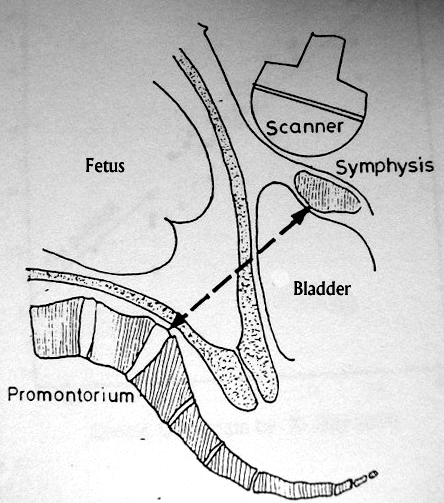 Conjuata vera obstetricanın ölçüldüğü 1978 de yayınlanan bir çalışmada USG ile pelvik ölçümün travayın başlamasından önce doğum komplikasyonlarının tanınmasında uygun bir metod olacağı; radyasyon