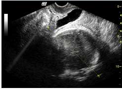 Ultrasonografik pelvimetrinin en önemli avantajı aynı anda fetüsün de değerlendirilebiliyor olmasıdır.