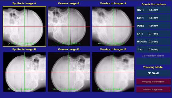 6D SKULL İZLEME TEKNİĞİ UYGULAMASI DRR (digitally reconstruction radiographs) referans.