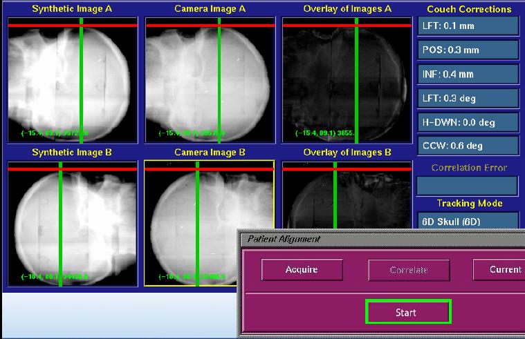 6D SKULL İZLEME TEKNİĞİ UYGULAMASI 3 doğrusal ve 3 açısal masa düzeltmeleri sistem tarafından otomatik olarak hesaplanır ve düzeltmeler otomatik olarak yapılır DRR Live