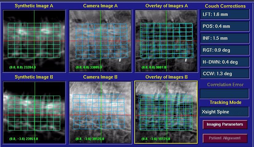 X-SIGHT SPINE İZLEME TEKNİĞİ UYGULAMASI Mesh adı verilen 9x9 (81nokta) alan içinde kontrast farkından