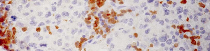 ZAP-70 ile tümör hücrelerinde