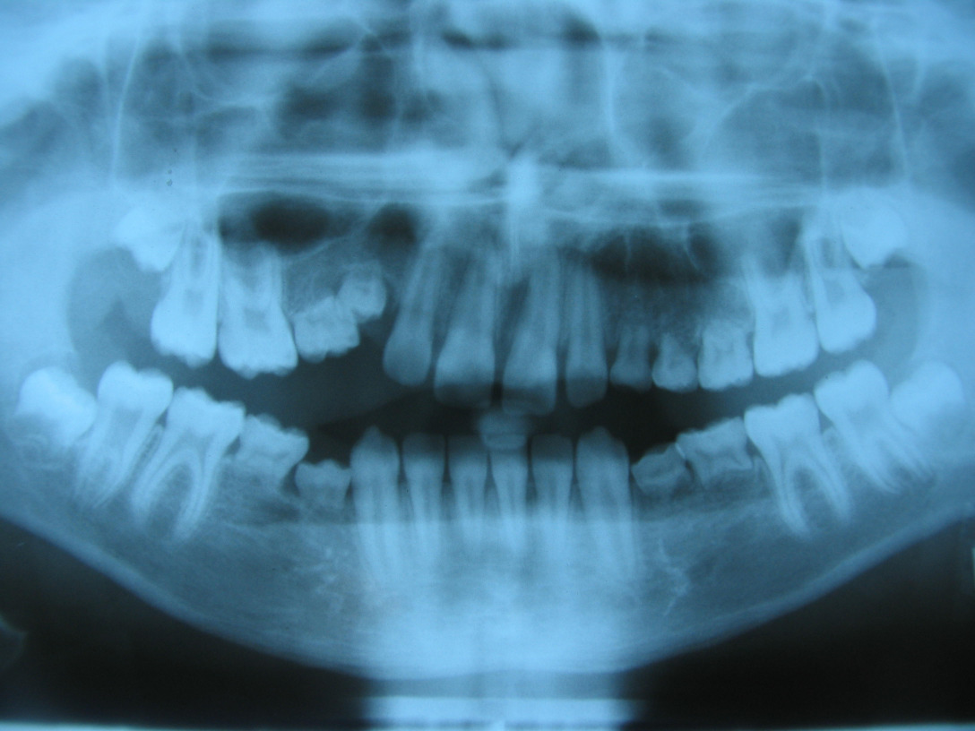 kesici dişlerdir. Konjenital eksiklik uni veya bi olabilir. 16 Bu çalışmada tüm çenelerde eksikliği en sık görülen dişler sıralandırıldığında ilk üç sırada 2. dişler, kesici dişler ve 1.
