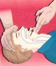 Çenesi yukarı kaldırılarak baş hafifçe arkaya itilir. 4.Ağızdan ağıza solunum yapılacaksa burun kapatılır.