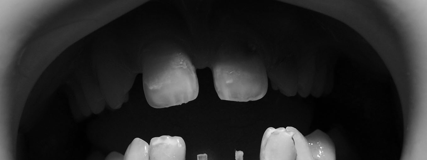 Endodontik tedavi uygulanmış ve aşırı miktarda madde kaybına uğramış dişlerin protetik ve konservatif tedavilerinde yeterli kuronal diş dokusunun bulunmaması, restorasyonları desteklemek için kök