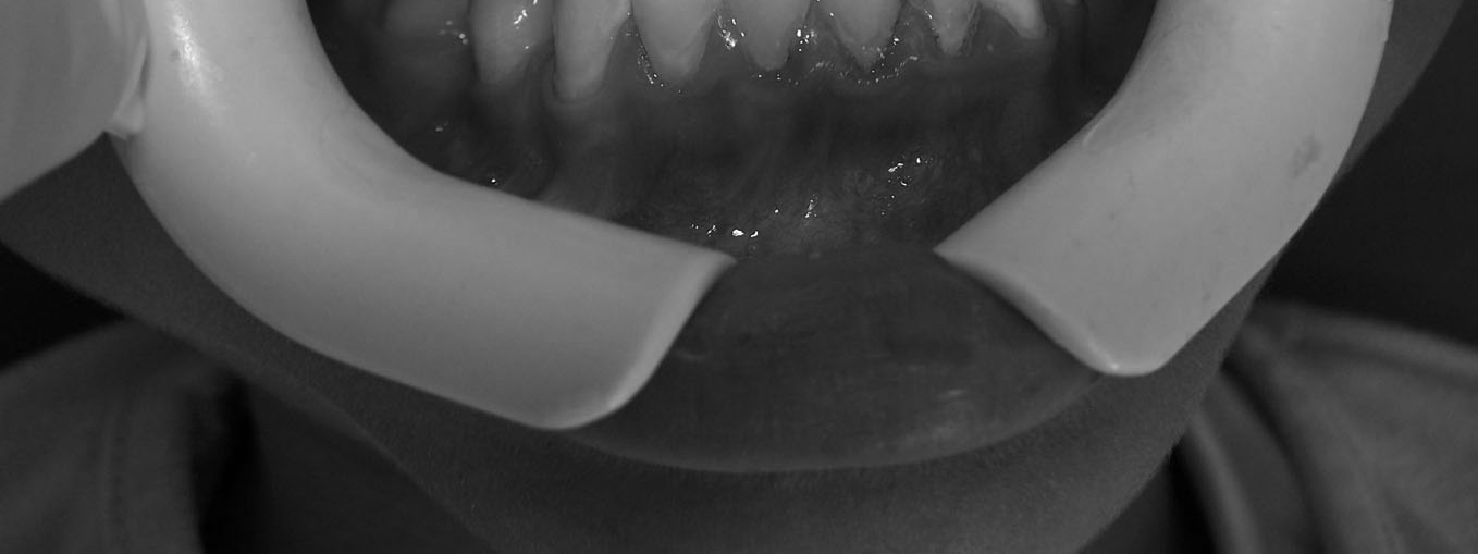 kırıkları önlemektir. Trabert ve ark. 6 kırığa karşı en önemli direncin kalan sağlıklı diş dokusu olduğunu belirtmiştir.