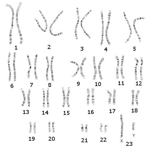 6 Figür 3: Belirli bir sıraya göre düzenlenmiş kromozomlar: Karyotip 7 doğru direktiflerin verilmesini engellerse, genetik bir hastalığa neden olabilirler.