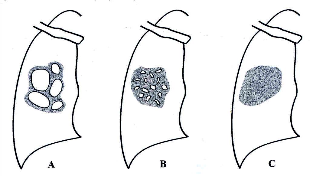 Konjenital kistik adenomatoid malformasyon Radyoloji: 3 tipe ayrılır.
