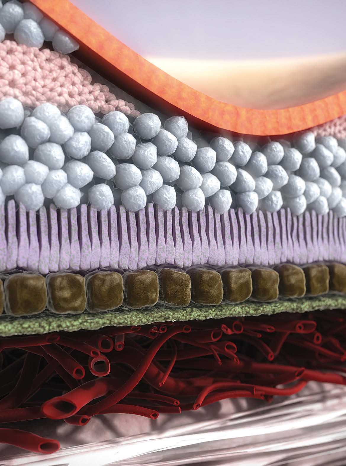 Sağlıklı retina Islak AMD deki retina Bir hastalık - iki tür Yaşlılığa bağlı maküla dejenerasyonu
