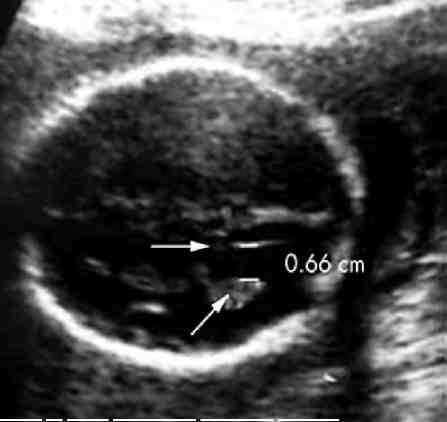 Derleme Fetal Ventrikulomegali Van Tıp Dergisi: 21(1): 54-59, 2014 Fetal İzole Hafif Ventrikulomegali, Ne Kadar Önemli?