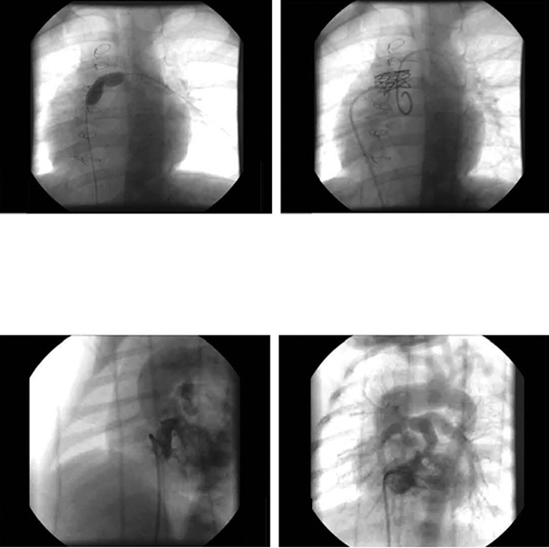 Şahin M ve ark. A Şekil 1. Fontan operasyonu yapılmış bir hastanın stent öncesi ve sonrası ön-arka pozisyonda anjiyografileri göstermektedir. A. Stent öncesi yapılan predilatasyonda balon şişirme sırasında darlık görülmektedir.