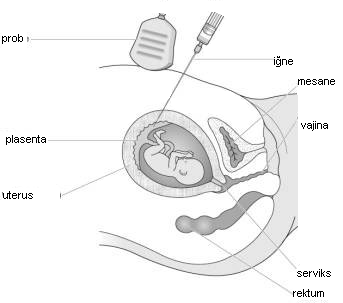 alınsa da (hafta başına 1ml) teknik, standart amniyosentez ile aynıdır.