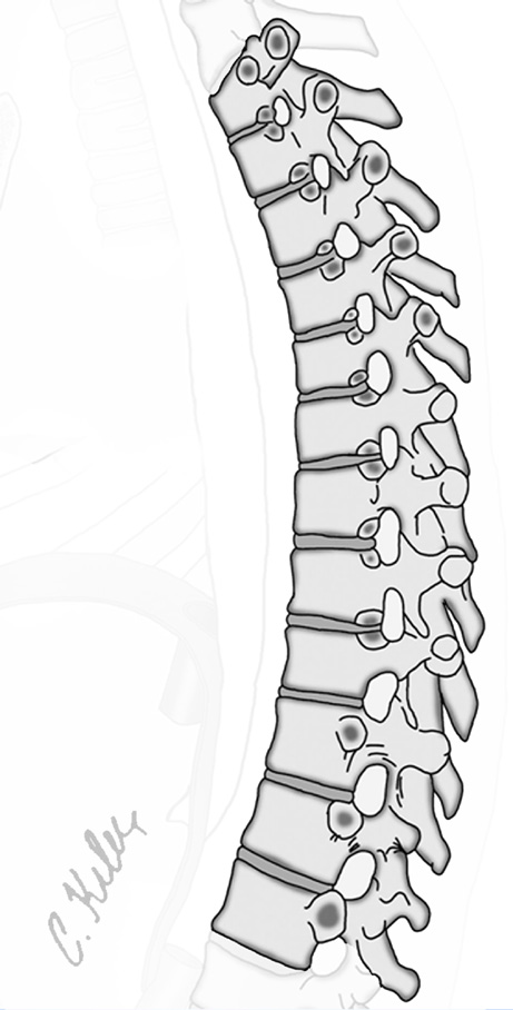 8 Torakal vertebralar On iki tane torakal vertebra vardır. Corpus ları (gövde) aşağıya doğru büyür. Corpus larında ve processus transversus larında kaburgalar için eklem yüzleri bulunur.