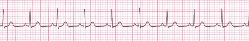 Özellik Çıkartma Aşağıdaki EKG işaretine doktorların genel yaklaşımı kalp atış hızı ve EKG işaretindeki her özel dalganın süresini hesaplayarak yapılır.