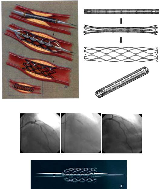 Yine Şekil 6.5 de gösterildiği gibi NiTi alaşımından yapılan ve yukarıda bahsedilen konuya benzer olarak üretilen stent, damar tıkanıklarında kullanılmaktadır.