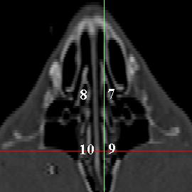 Şekil 3.16. Sinus paranasales in coronal MDBT görüntüsü.