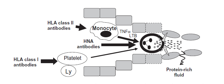 HLA Class II TRALI ile ilişkili En sık görülen Nötrofil ve endotelden eksprese edilmez*.