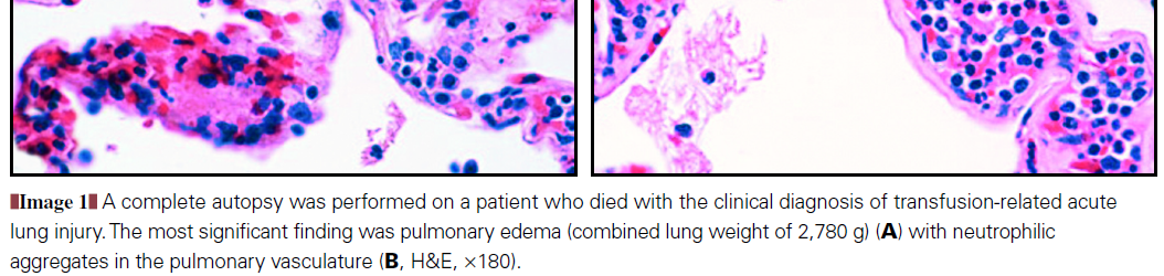 MPO poz Pulmoner ödem