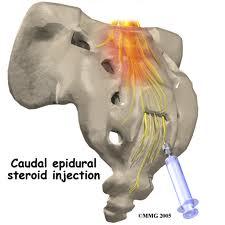 KAUDAL EPİDURAL STEROİD ENJEKSİYONU Yüzüstü pozisyon