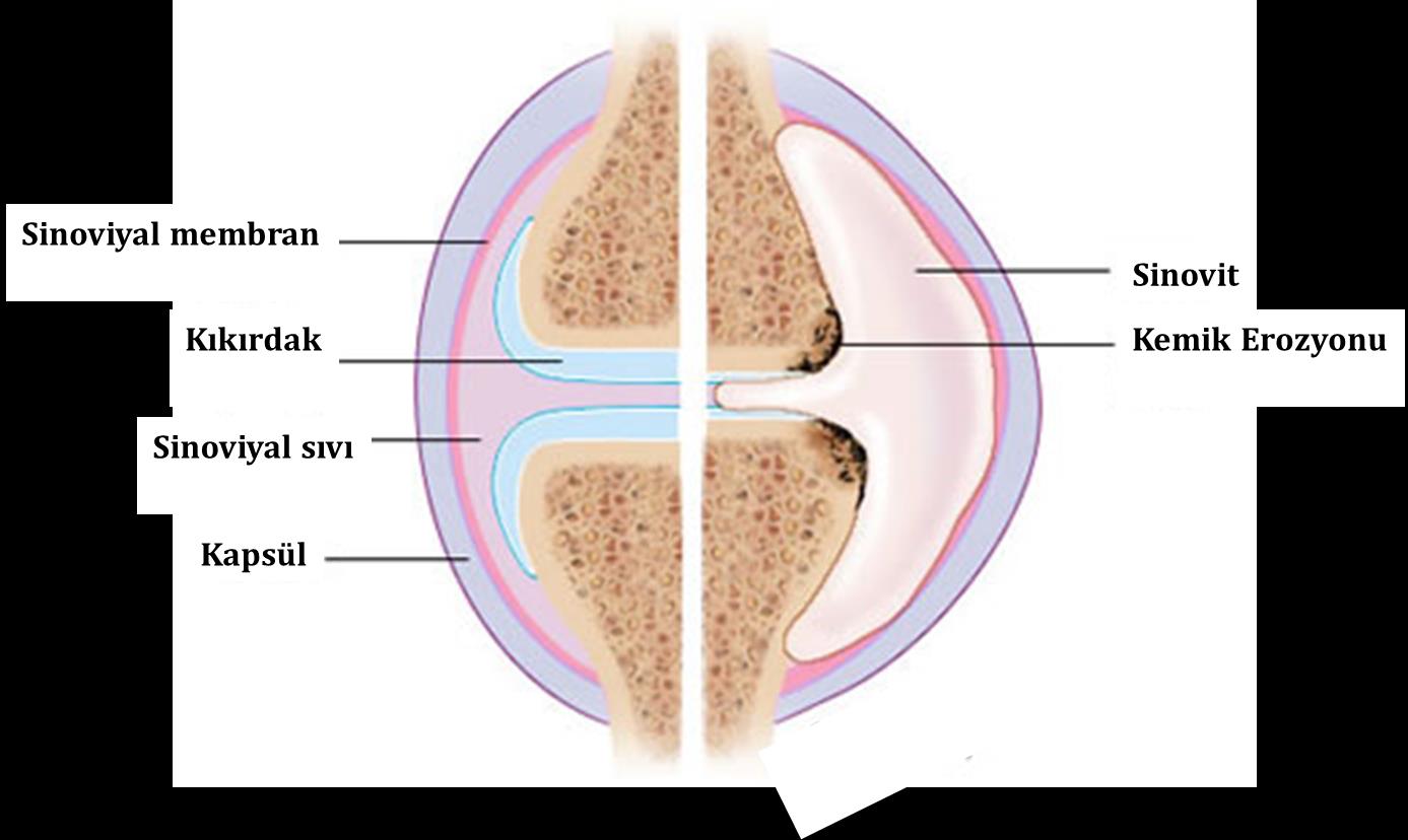 sinovyumda (sinoviyal sıvıyı saran zar) genişlemeye neden
