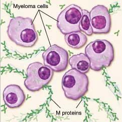 Plazma hücre diskrazileri anormal plazma hücrelerinin klonal çoğalma gösterdiği hastalıklar grubudur.