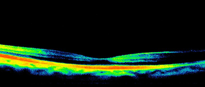 Olgu 6 :Fundus muayenesinde Koryoretinal atrofisi olan kontrol grubu hastas8 sa?