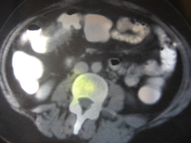 19 BT, MR ve PET (Pozitron emisyon tomografisi) kolon kanserinin teşhisinde ilk başvurulacak teşhis yöntemleri olmayıp hastalığın evrelenmesinde ve yakın ve uzak metastaz varlığının gösterilmesinde