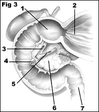 Anatomi 1. Duodenal Bulbus 2.
