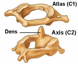 Servikal vertebra tutulumunun erken bulgusu boyunda oksiputa doğru yayılan ağrı ve