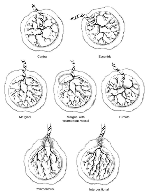 Resim 3. Plasentanın yapısal anomalileri (umblikal kord açısından) Kaynak: Manual of Benirschke and Kaufmann's Pathology of the Human Placenta. Springer; 1 ed.