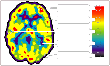 Serebral aktivitenin ölçülmesi-pet oksijen karbon hidrojen Fluorine-18 Çok