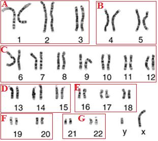 Bu evrede çok iyi görülen kromozomlar giemsa ile boyanır. Resimleri çekilir ve dizilirler (Şekil 5 ve 6). Kemik iliği lenfositleri hazır preperatı 10x40 mikroskop büyütmesinde incelenir. Şekil 5.