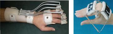 Eklem kontraktürlerini ve eklem ya da tendon subluksasyonlarını düzelterek eklem deformitesi oluģumunu engeller.