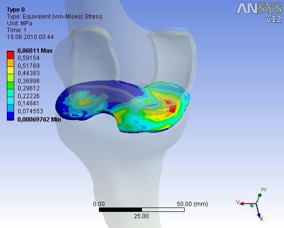 Tablo 1. Malzeme özellikleri. Yapı Elastik Modülüs (E, MPa) Poison oranı (v) Tibia 14.000 0.3 Femur 17.000 0.3 Menisküs 59 0.49 Kıkırdak 5 0.46 Tablo 2.