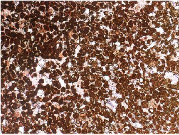 Resim 31. Boyanmış kesit, Karbonifer, İngiltere, X27 Tek Nikol 2 Resim 31 de Nispeten ince kılıfsı kaplamalı kırıntılı kuvars çekirdekli ooidleri göstermektedir.