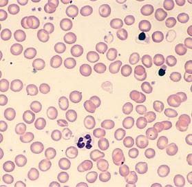 12: Talasemide frajil eritrositler Talasemilerin içinde en ağır, klinik belirtileri olan ve ilerleyen Ģeklidir. Vücut için yeterli hemoglobin yapılamamaktadır.