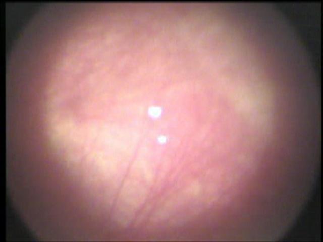 Tablo 5. Prematüre retinopati vasküler proliferasyon evresi ve klinik bulgular (115) Evre 1: Demarkasyon hattı PR nin ilk patognomonik oftalmoskopik bulgusudur.