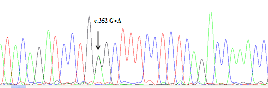 Şekil IV.8. BMP15 geni c.352 G>A heterozigot mutant saptanan olgu 77 ye ait dizi analizi görüntüsü.