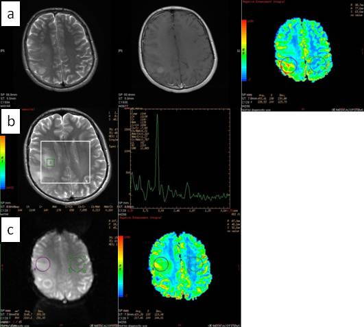 Resim 8. 20Y erkek hasta, Grade 3 anaplastik astrositom a) Sağ parietal lobda T2A sekansta hiperintens karakterde, kontrast verilimini takiben kontrast tutulumu izlenen kitle lezyon.