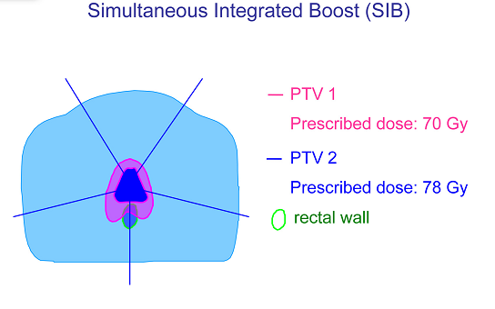 Simultane Integrated Boost(SIB) İki