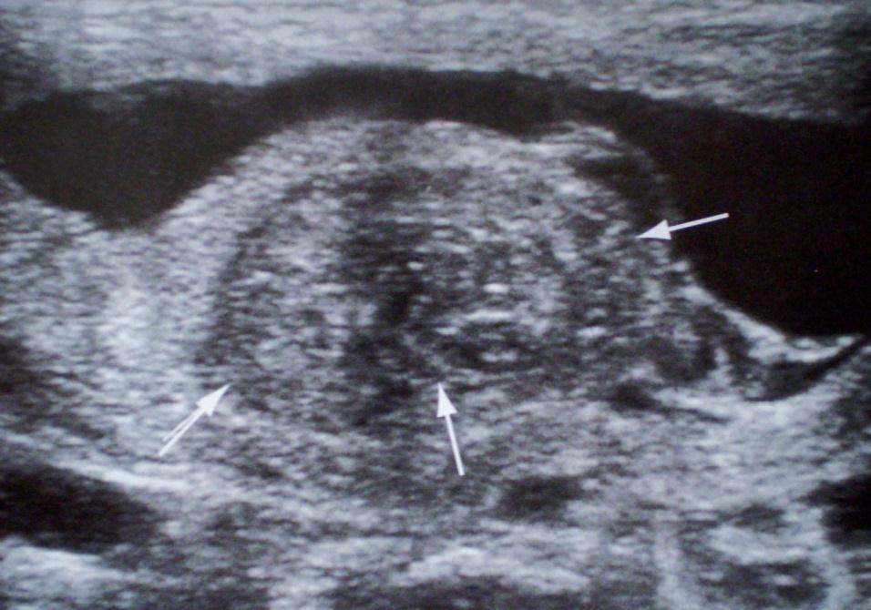 Obstet Gynecol 1987 Retroplasental hematom görülme oranı