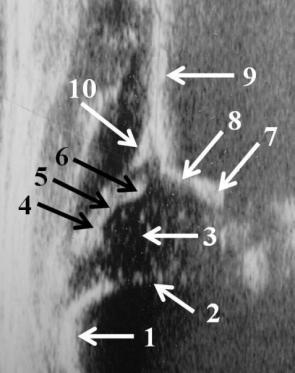 Şekil 4: İnfantil kalça ultrasonografisi.