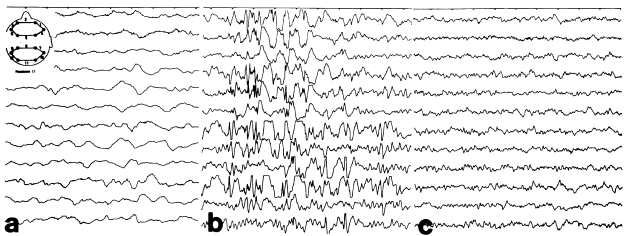 Severe encephalopathy with epilepsy in an infant caused by subclinical maternal pernicious anaemia.