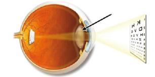 Şaşılık: Gözü hareket ettiren kasların uyumsuzluğu sonucunda oluşur, ameliyatla giderilebilir. Sonradan oluşan göz hastalıklarından bazıları; Miyopluk: Görüntü sarı lekenin önünde oluşur.