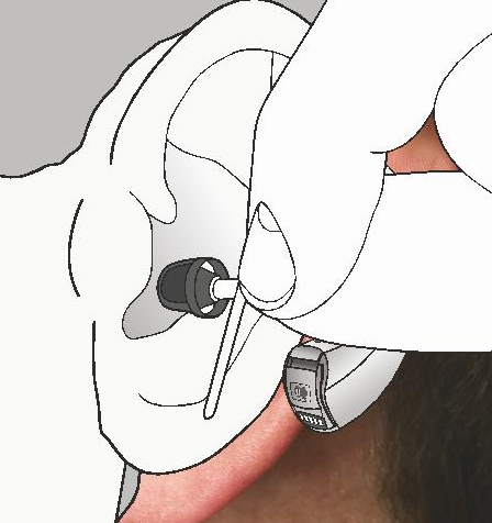 Cihazı Takma ve Çıkarma İşitme Cihazını ve Kişiye Özel Kulaklığı çıkarmak için: 1. Kilidi kulağınızın konkasından çıkarın.