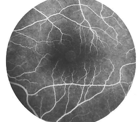 EKİL 8 MAKULA DELİĞİNİN AYIRICI TANISI Tam kat bir makula deliği, santral makulada yaklaşık 400-500 µ çapında, yuvarlak, keskin sınırlı ve etrafında 1200-1500 µ çapında retina dekolmanı ile