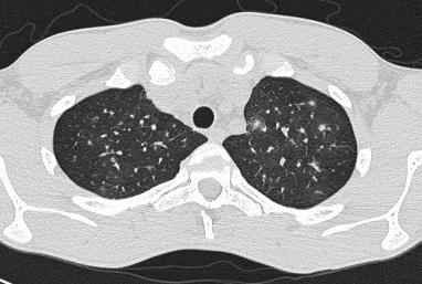 BT de özgül bulgular nodules