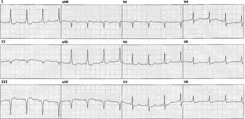 Sağ posteroseptal aksesuar yol Haghjoo